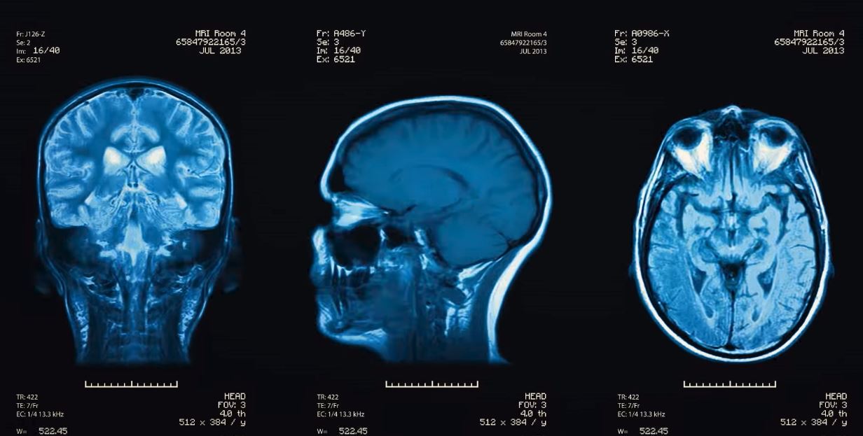 head injury concussion xray scan mri