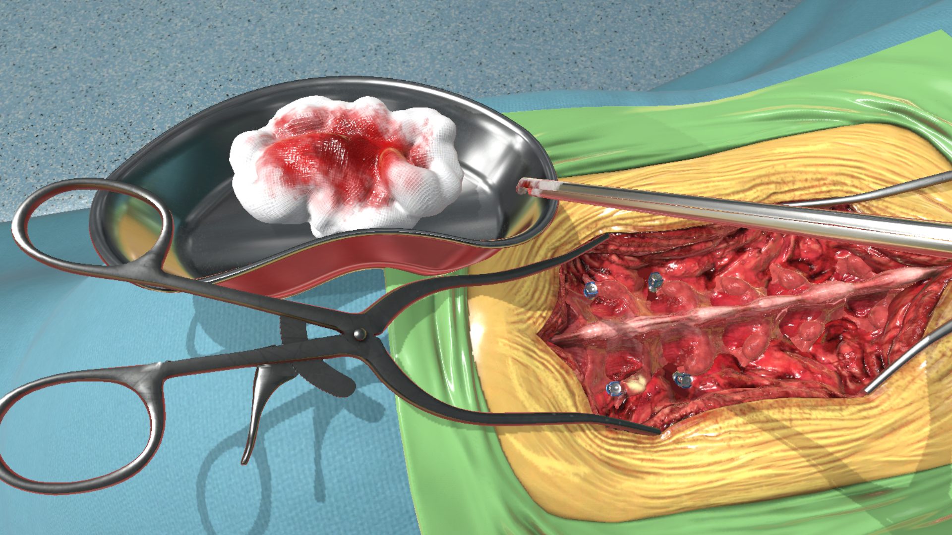 Fundamental Surgery - Facetectomy 2