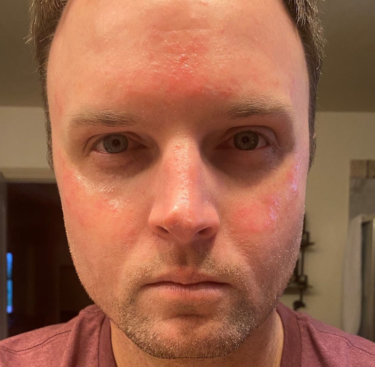 oculus quest 2 skin irritation